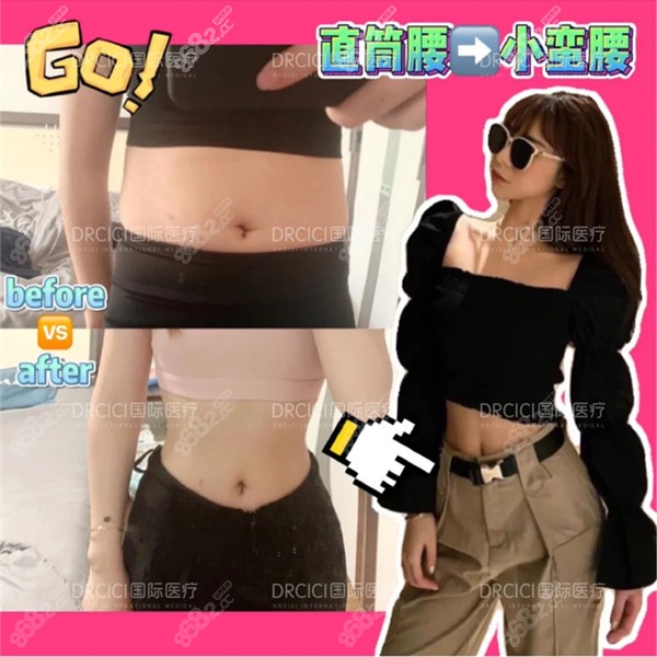 <!--<i data=20240705-sp></i>-->徐鹤然腰腹环吸案例