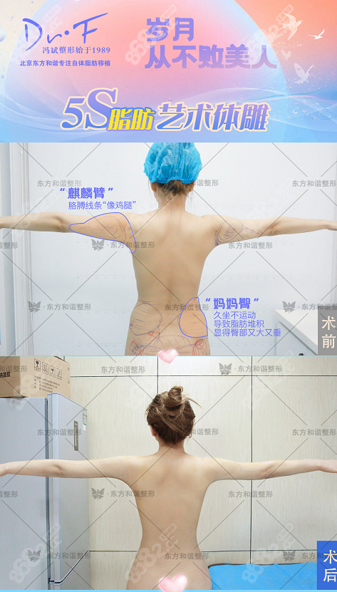北京东方和谐孙泽芳臀部吸脂和手臂吸脂案例