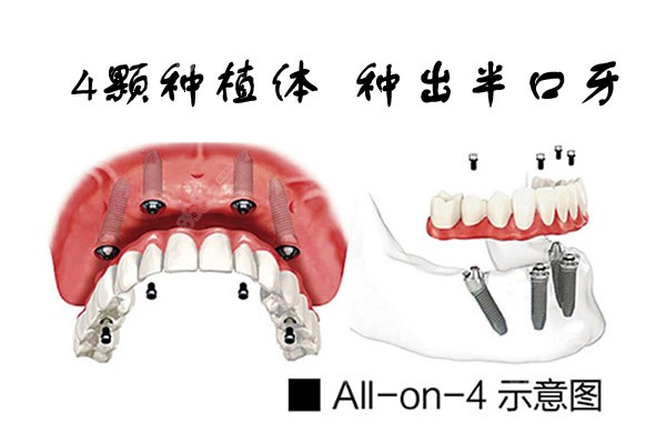 all-on-4半口种植牙