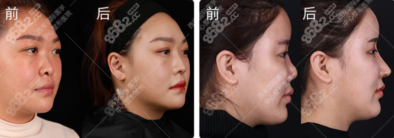 师俊莉大鼻头塌鼻整形效果图