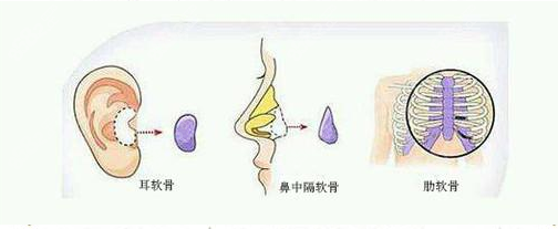 隆鼻常见自体软骨材料