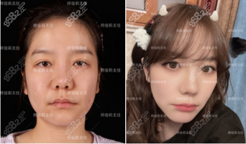 师俊莉隆鼻案例图2