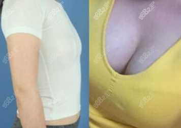 <!--<i data=20240705-sp></i>-->內(nèi)窺鏡隆胸案例