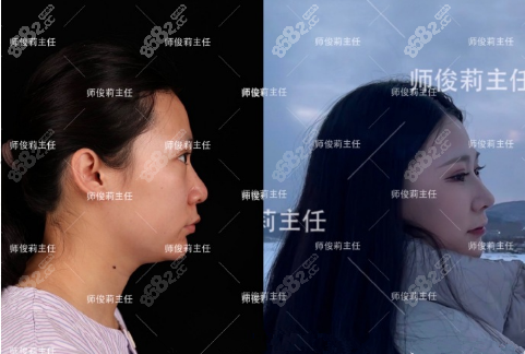 师俊莉隆鼻案例图1