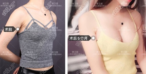 上海华美假体隆胸前后对比图