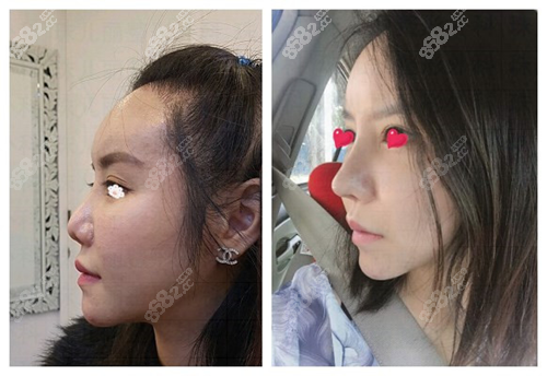 韩国珠儿丽医院鼻修复案例