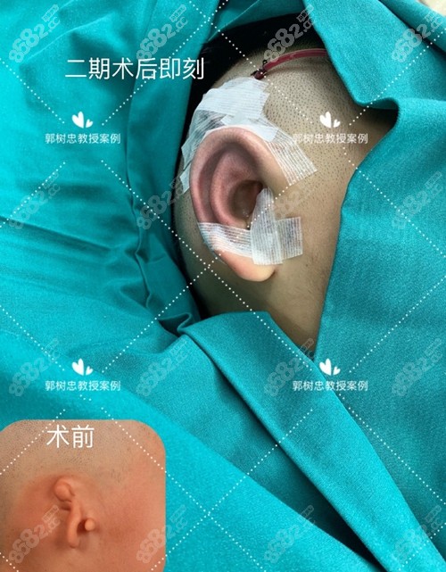 <!--<i data=20240705-sp></i>-->肋软骨耳部再造耳术后效果