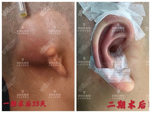 <!--<i data=20240705-sp></i>-->肋软骨耳部再造耳术前后效果对比