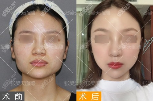 北京圣嘉新長(zhǎng)曲線下頜角截骨案例