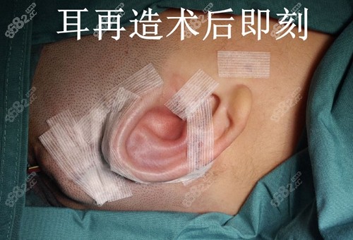 用肋软骨做的耳朵能用一辈子吗