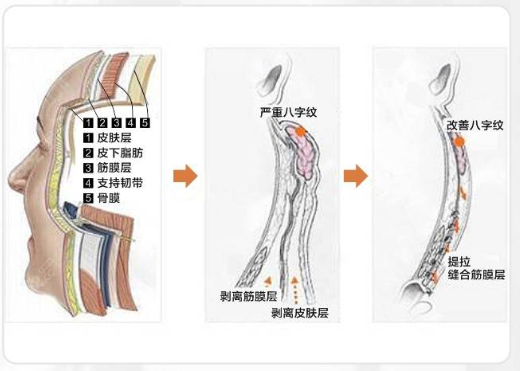 李湘源风筝提拉术对比传统手术拉皮除皱的优势