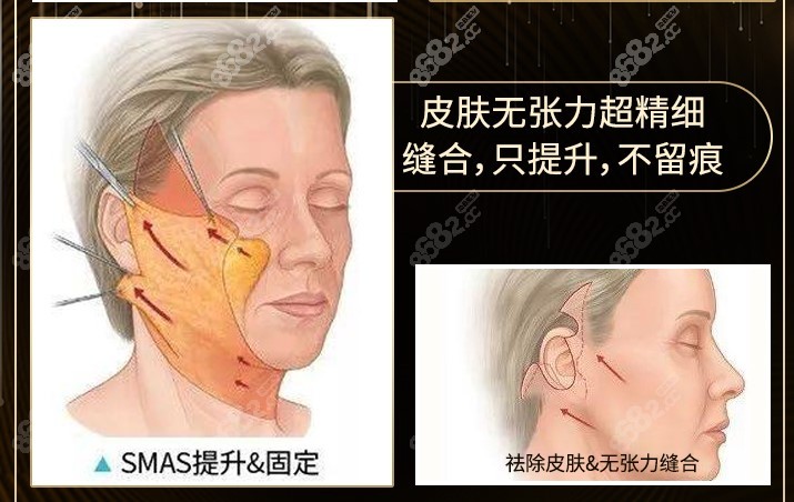 广州中家医家庭医生SMAS提升除皱术优势在哪？