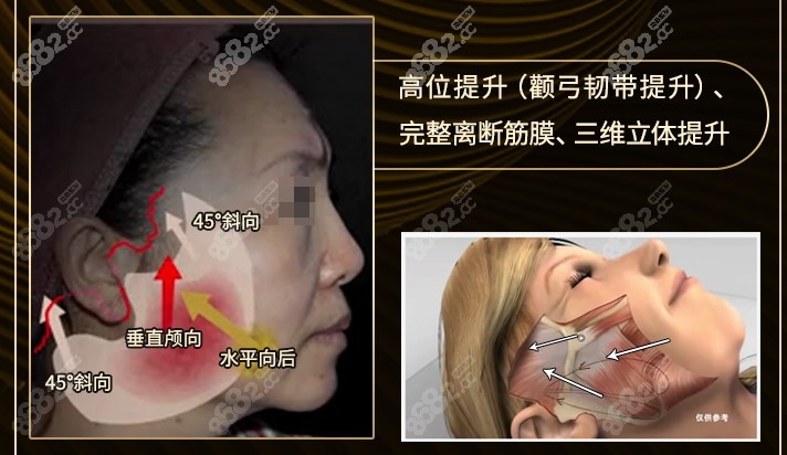 广州中家医家庭医生SMAS提升除皱术优势在哪？