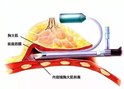 金辉整形医生做假体隆胸用内窥镜