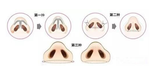 如何使鼻翼变小的方法三