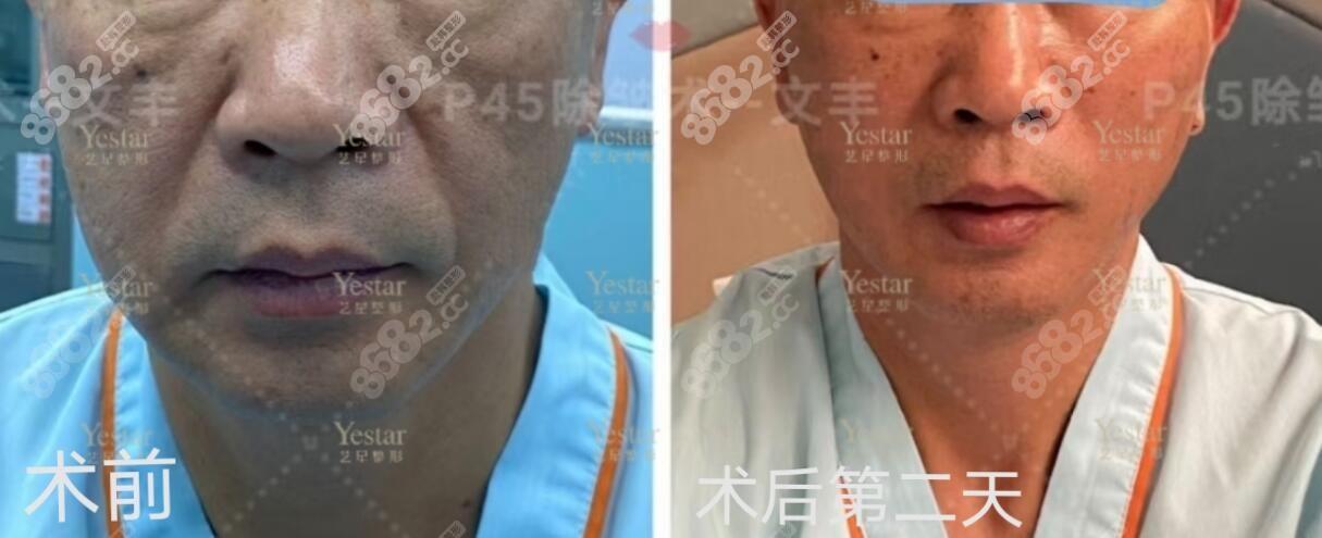 58岁王叔在深圳艺星做多锚点SMAS筋膜拉皮手术第2天恢复图