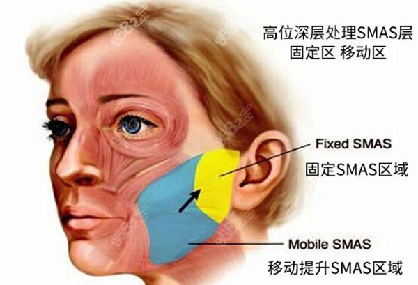 广州中家医家庭医生推荐的高位smas除皱术