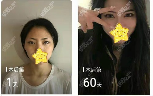 西安国 际医学<!--<i data=20240705-sp></i>-->孙峰眼修复案例