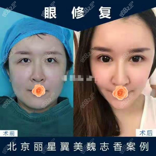 北京丽星翼美魏志香眼修复案例