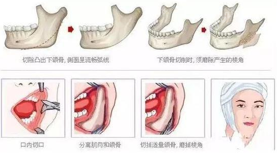 深圳磨骨罗琦难预约吗？