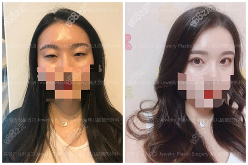 韩国珠儿丽眼修复案例