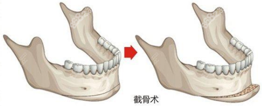 深圳磨骨哪个医生好？