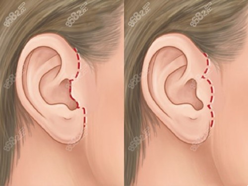 耳前拉皮手术切口