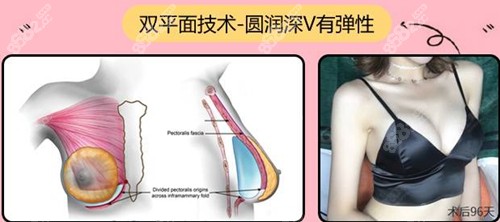 谢卫国院长隆胸术后效果