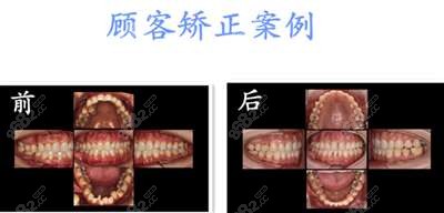 秦皇岛瑞格口腔种植矫正中心矫正案例