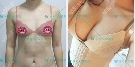 北京东方和谐自体脂肪隆胸案例图片参考