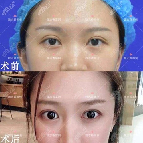 北京丽星翼美双眼皮修复案例