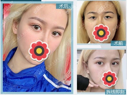 东篱医院割双眼皮案例