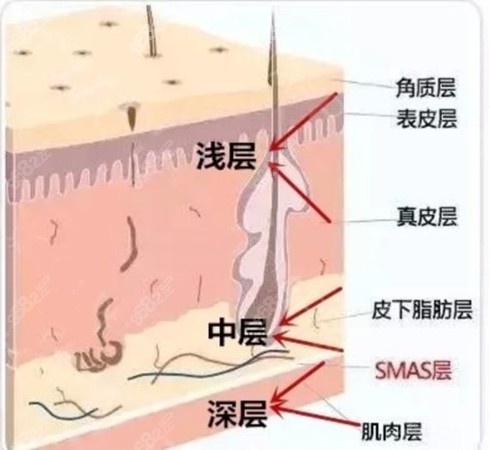 V美减龄是什么手术？是肌肉层的提拉