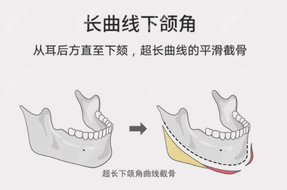 上海华美李志海做下颌角怎么样