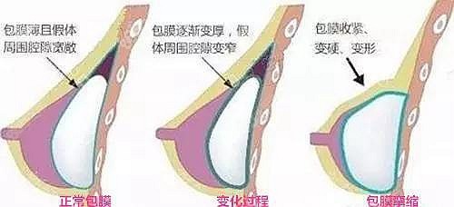 沈正宇做假体隆胸的优势