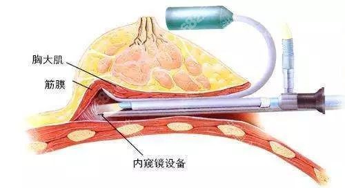 沈正宇隆胸技术好吗