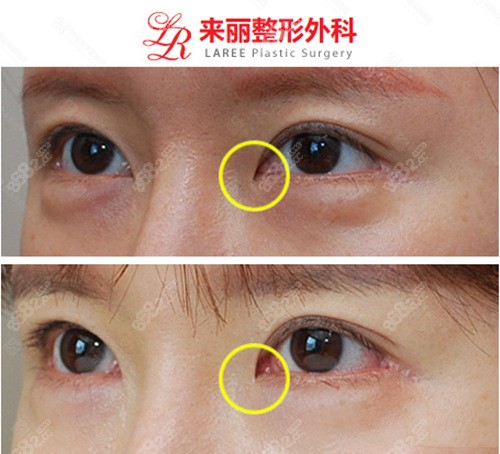 韩国来丽整形医院开眼角<span style=