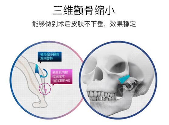 上海华美李志海做颧骨内推怎么样ng
