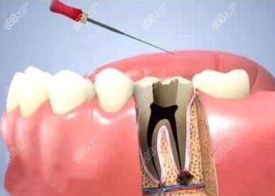 牙齿根管治疗后牙齿的寿命是多长