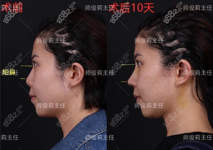 西安国 际医学中心整形医院师俊莉耳软骨隆鼻案例