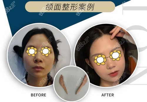 下颌角磨骨案例