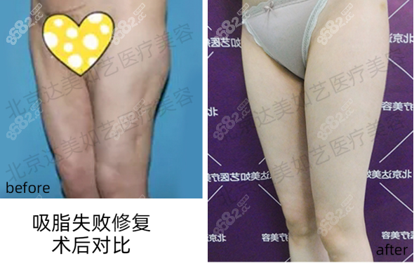 北京达美如艺大腿抽脂后重度凹陷修复效果图