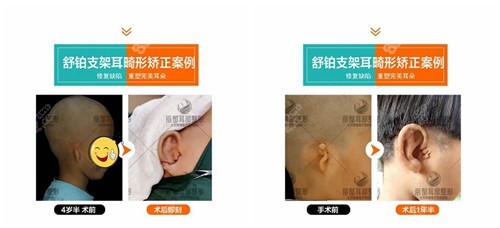 北京米兰柏羽丽都耳部整形中心安波做耳畸形矫正案例