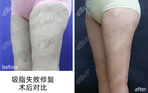大腿抽脂后有硬块凹凸不平修复效果图
