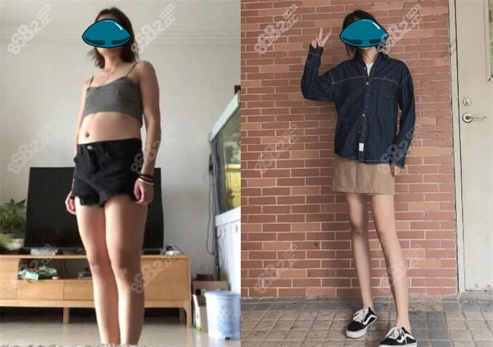 苏州康美医院全身抽脂案例效果对比图