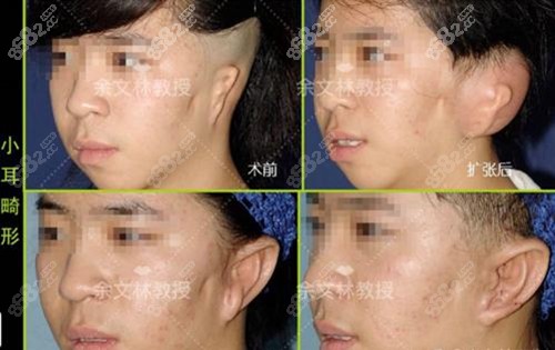广州高尚医学美容中心余文林做耳畸形矫正案例