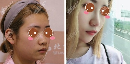 北京画美徐学东肋软骨鼻综合案例