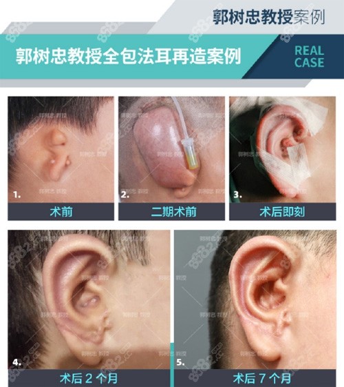 西安国 际医学中心<!--<i data=20240705-sp></i>-->做耳再造案例前后对比