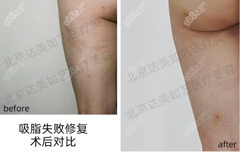 大腿后侧吸脂坑坑洼洼修复对比图