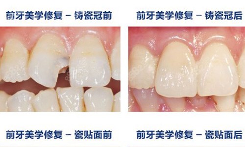 南京美奥口腔牙齿贴面修复<span style=